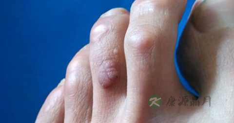 激光瘊子疼吗