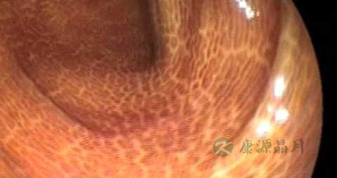 黑变病能治好吗 黑变病能治好吗
