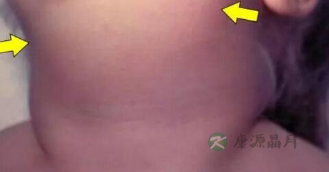 慢性化脓性腮腺炎怎么办 慢性化脓性腮腺炎怎么办