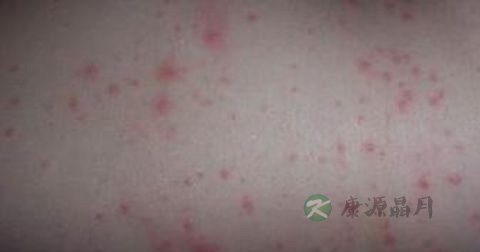 传染性红斑的病因