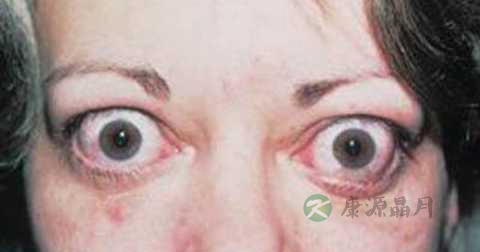 甲亢突眼能治吗 甲亢突眼能治吗