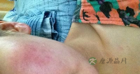 丘疹能自愈吗