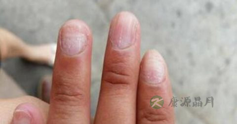 灰指甲是传染病吗