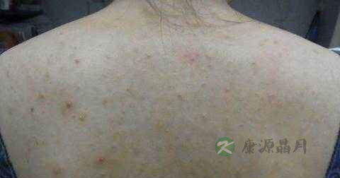 玫瑰藓治疗方法 玫瑰藓治疗方法