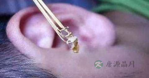 中耳炎的禁忌 中耳炎的禁忌