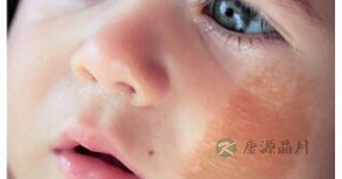 红色胎记怎么治 红色胎记怎么治