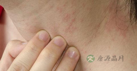 毛囊炎是怎么回事 毛囊炎是怎么回事