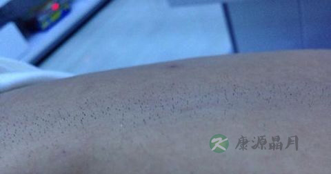 毛囊炎能吃阿莫西林吗
