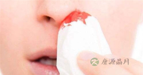 如何预防流鼻血 如何预防流鼻血