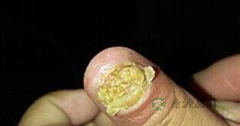 甲沟炎化脓了怎么办 甲沟炎化脓了怎么办
