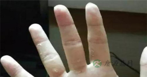 手藓用什么药好