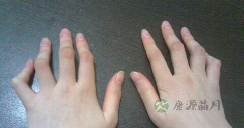 接触性皮炎传染吗 接触性皮炎传染吗