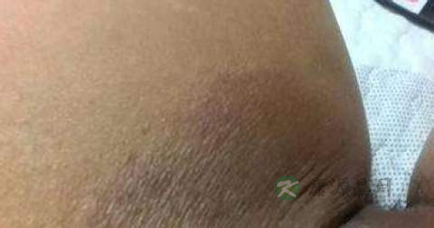 如何预防色素沉着 如何预防色素沉着
