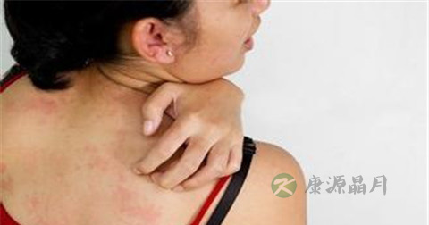 荨麻疹怎样护理 荨麻疹怎样护理