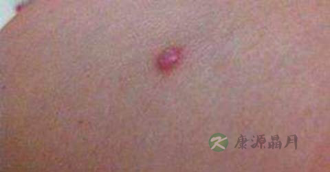 疖子化脓了怎么办 疖子化脓了怎么办