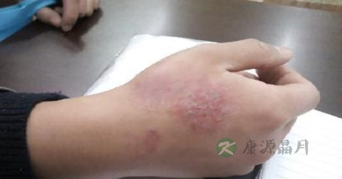 丘疹能自愈吗