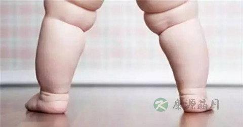 先天性髋关节脱位能治好吗 先天性髋关节脱位能治好吗