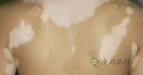 白驳风在能治好吗 白驳风在能治好吗