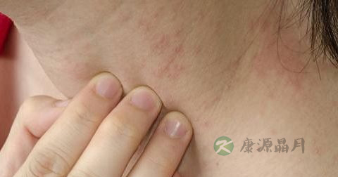 面部脂溢性皮炎可以吃鱼吗