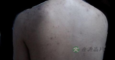 毛囊炎能吃阿莫西林吗