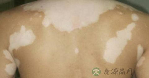 手上白癜风怎么治 手上白癜风怎么治