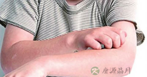 皮炎都会痒吗