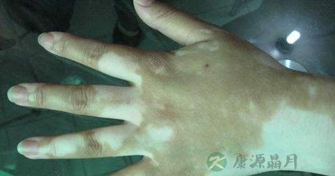 白驳风在能治好吗 白驳风在能治好吗