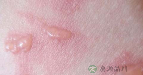 如何处理烫伤的大水泡 如何处理烫伤的大水泡