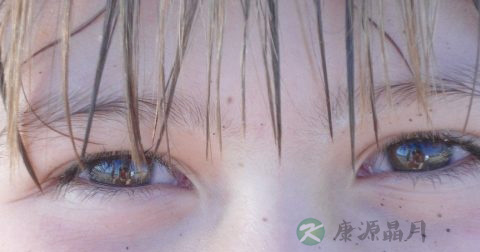 眼结膜上有异物怎么办