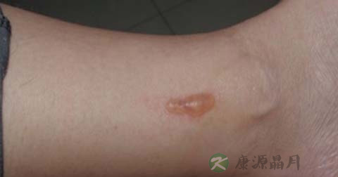 如何处理烫伤的大水泡 如何处理烫伤的大水泡