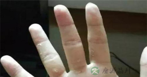 热水烧伤怎么紧急处理 热水烧伤怎么紧急处理