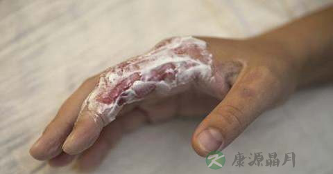 脸和手被鞭炮炸伤怎么办