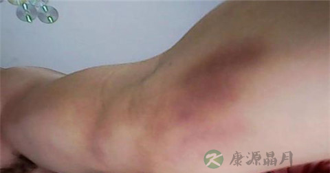 小孩摔倒青了如何去青 小孩摔倒青了如何去青