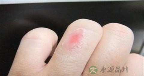 热水烧伤怎么紧急处理 热水烧伤怎么紧急处理