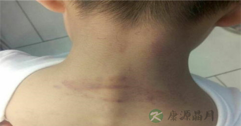 小孩摔倒青了如何去青 小孩摔倒青了如何去青