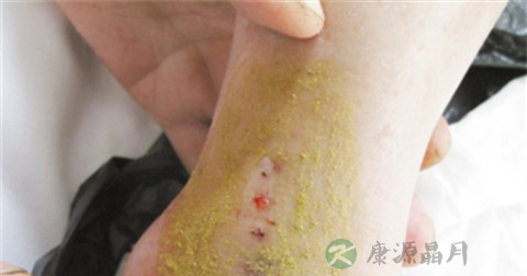 毒蛇咬伤后的急救措施 毒蛇咬伤后的急救措施