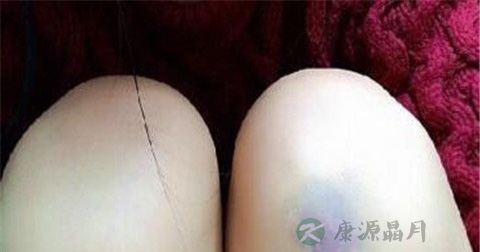 小孩摔倒青了如何去青 小孩摔倒青了如何去青