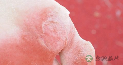 糖尿病患者早期饮食如何安排 糖尿病患者早期饮食如何安排