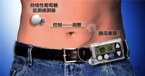 使用胰岛素泵的注意事项 使用胰岛素泵的注意事项