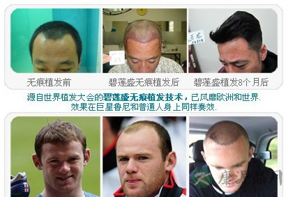 植发的背后解析 关于公开、披露与技术的一切 植发的背后解析 关于公开、披露与技术的一切