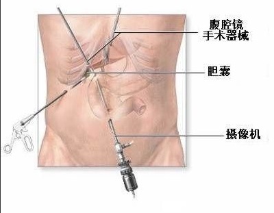 胆囊息肉警惕过度治疗 合理治疗是关键! 胆囊息肉警惕过度治疗 合理治疗是关键!
