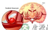 高血压脑出血的治疗 高血压脑出血的治疗