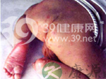 惊叹：孩子也会有性病