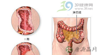 防癌变 结肠息肉早切除 防癌变 结肠息肉早切除