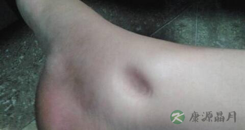 老人脚肿是什么原因引起的 老人脚肿是什么原因引起的