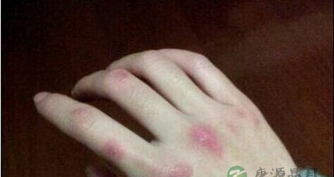 冻疮的原因 冻疮的原因