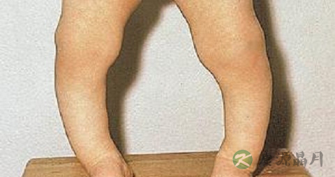 维生素D缺乏性佝偻病的原因 维生素D缺乏性佝偻病的原因