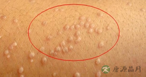 汗管瘤的症状 汗管瘤的症状