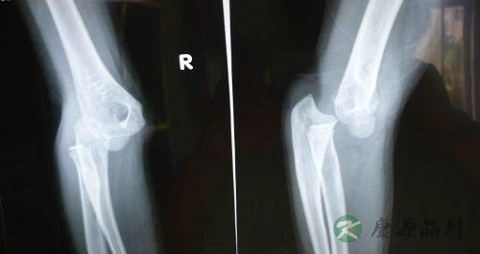 肘关节脱位的症状 肘关节脱位的症状