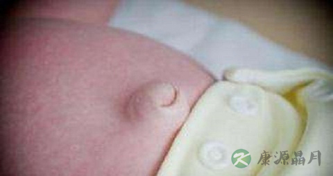 婴儿脐疝不能吃什么,婴儿脐疝的注意事项 婴儿脐疝不能吃什么,婴儿脐疝的注意事项